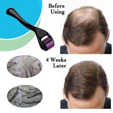 Derma roller for Hair Growth, microneedle, hair booster, haircare.